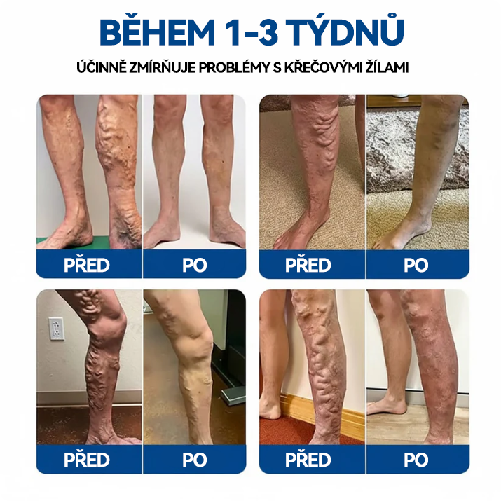 🏆🏆🇨🇿👨‍⚕️✅TAILEDEN® VeinEase Mikronáplast s mikrojehličkami⚡Okamžitá úleva, dlouhodobé výsledky