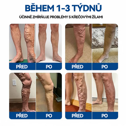 🏆🏆🇨🇿👨‍⚕️✅TAILEDEN® VeinEase Mikronáplast s mikrojehličkami⚡Okamžitá úleva, dlouhodobé výsledky