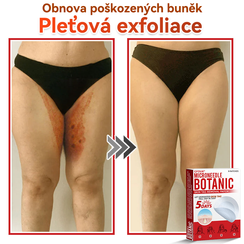 🔥🔥GFOUK® Mikrojehličková botanická náplast na odstranění bradavic