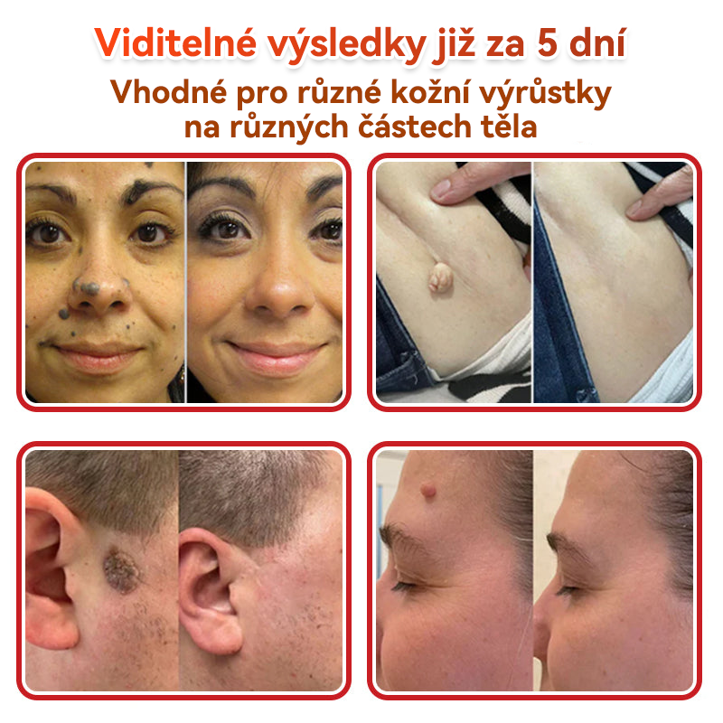 🔥🔥GFOUK® Mikrojehličková botanická náplast na odstranění bradavic