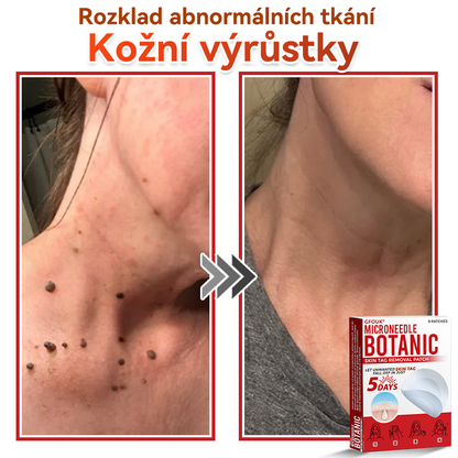 🔥🔥GFOUK® Mikrojehličková botanická náplast na odstranění bradavic