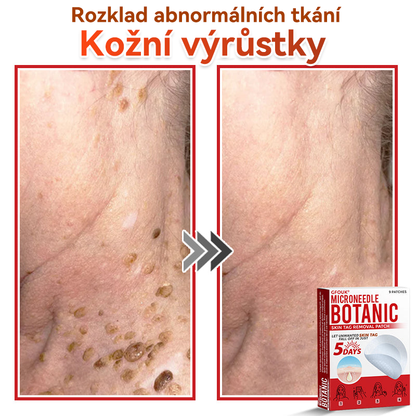 🔥🔥GFOUK® Mikrojehličková botanická náplast na odstranění bradavic